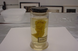 Un intestin de 200 ans révèle une souche ancienne du choléra